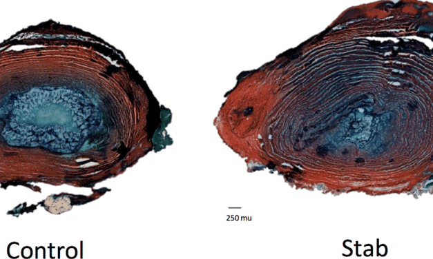 Interactions between disc degeneration and multifidus atrophy