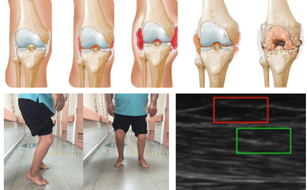 Functional implication of myofascial force transmission in hemophilia patients with severe joint damage