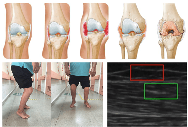 Functional implication of myofascial force transmission in hemophilia patients with severe joint damage
