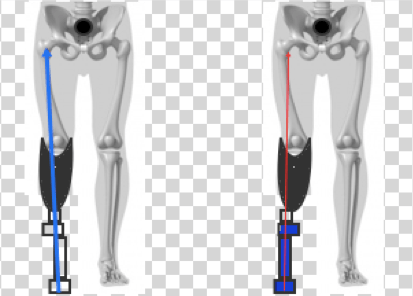 Kinetic gait data to quantify socket fit and prosthetic alignment in amputees